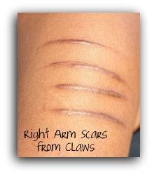 Cotton's Scars on Right Arm2redo.jpg