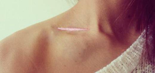 Collar bone scar.jpg