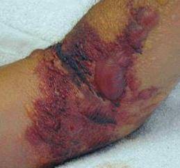 snake bite.jpg