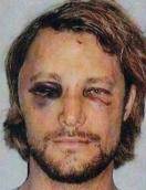 black eye.jpg